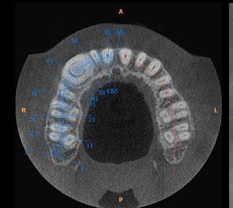 Axial CBCT view of the arch with section lines