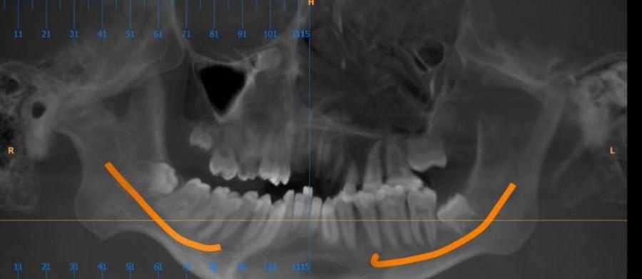 CBCT panoramic view with the mandibular nerve canal traced