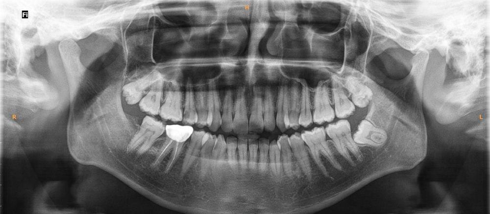 Panoramic OPG X-ray of a full adult dentition
