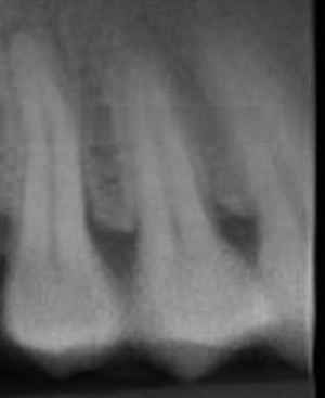 Intraoral periapical (IOPA) radiograph