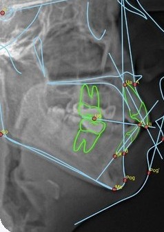 Ceph AI Analysis: landmarks and tracing on a lateral ceph