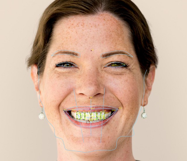 Frontal patient photo analysis with facial proportion lines