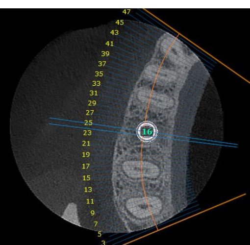 Axial slice with tooth numbering