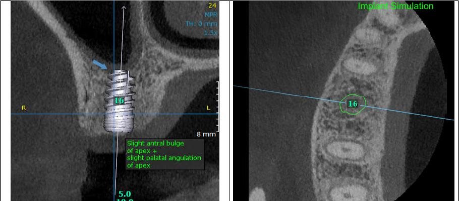 Implant site assessment with a virtual implant