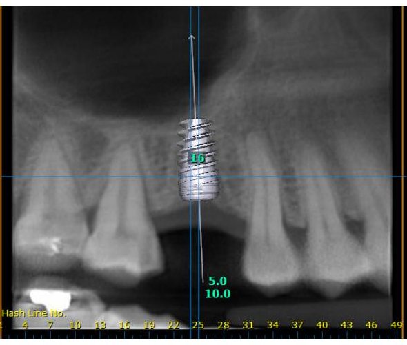 Implant simulation on the panoramic view