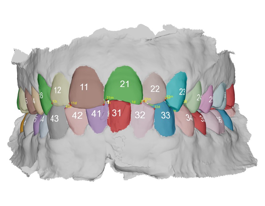 IOS Analysis: Bolton analysis on an intraoral scan with each tooth numbered